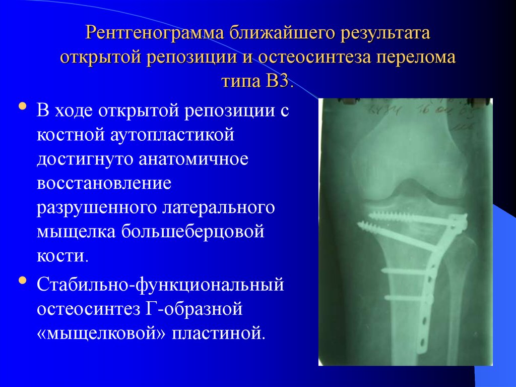 Мыщелка большеберцовой кости. Остеосинтез наружного мыщелка большеберцовой кости. Остеосинтез латерального мыщелка большеберцовой кости рентген. Остеосинтез наружного мыщелка большеберцовой кости пластиной. Стабильно функциональный остеосинтез.