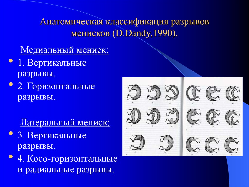 Анатомическая классификация разрывов менисков (D.Dandy,1990).