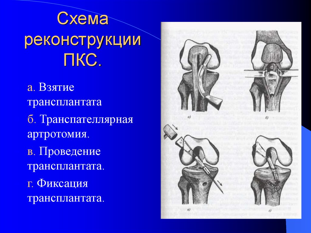 Повреждения и заболевания коленного сустава презентация