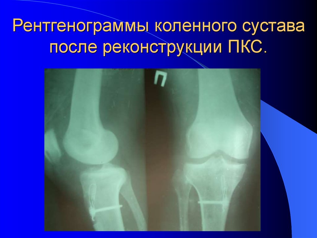 Рентгенограммы коленного сустава после реконструкции ПКС.