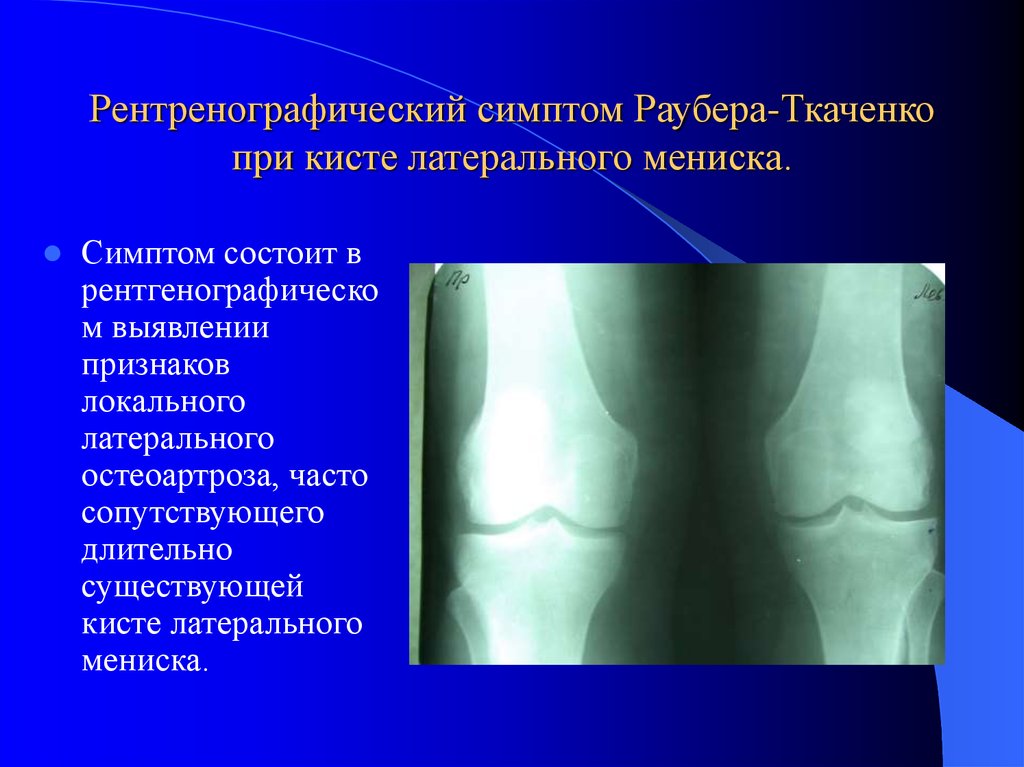 Рентренографический симптом Раубера-Ткаченко при кисте латерального мениска.