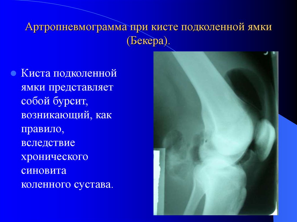 Подколенная киста. Обызвествленная киста Бейкера коленного сустава рентген. Киста Бейкера коленного сустава рентген. Киста коленного сустава на рентгене. Киста Бейкера коленного сустава на рентгенограмме.