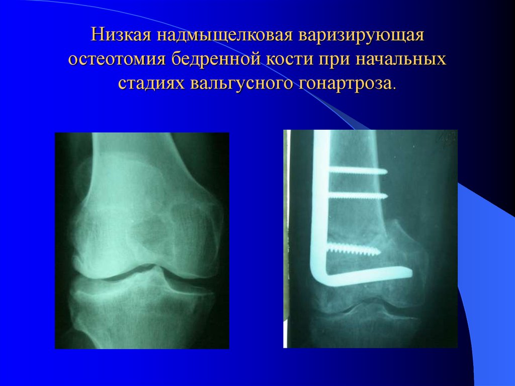 Низкая надмыщелковая варизирующая остеотомия бедренной кости при начальных стадиях вальгусного гонартроза.