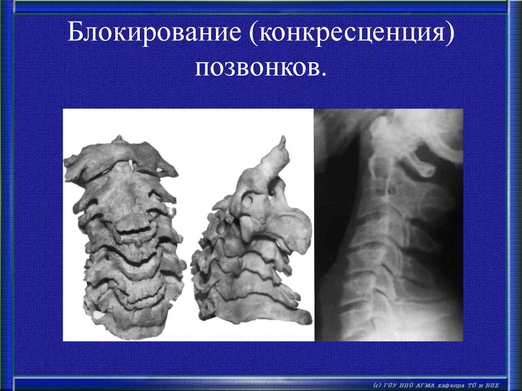 Конкресценция позвонков