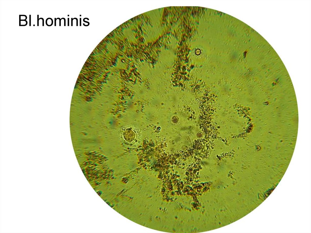 Бластоцисты в кале лечение. Бластоцисты в Кале. Бластоцисты хоминис.