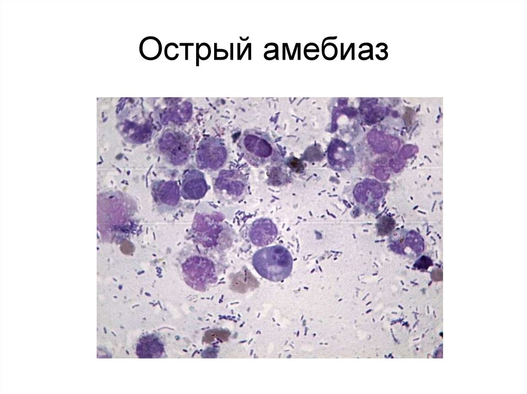 Острый амебиаз