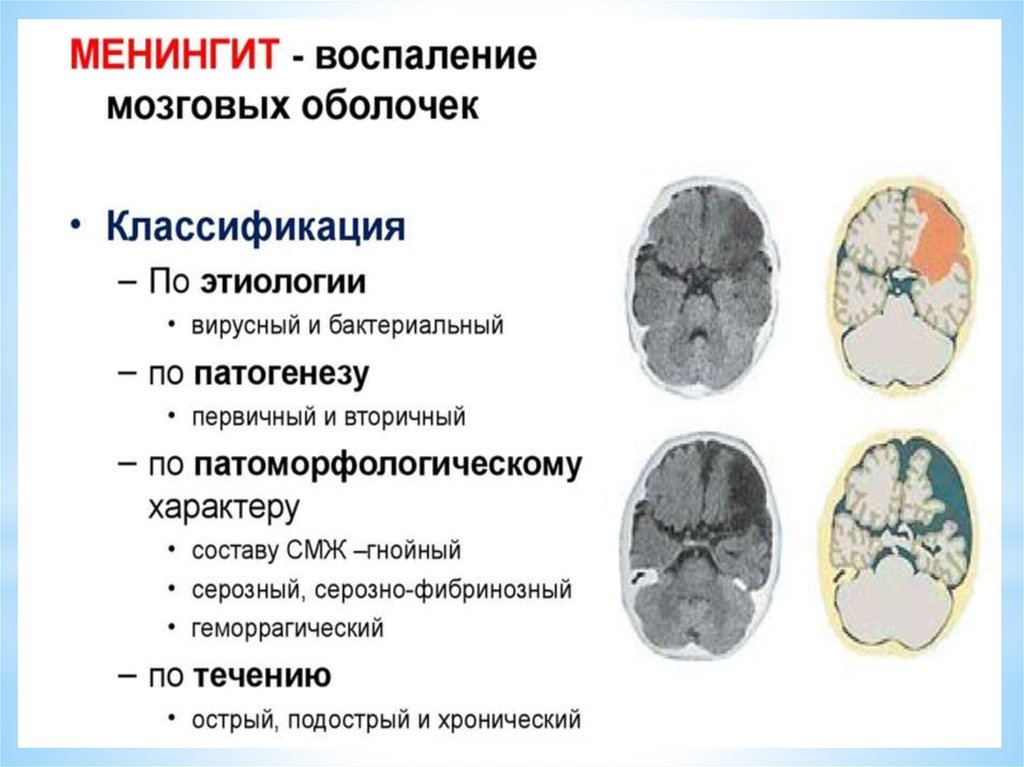 Поражение головного мозга лечение. Вторичный Гнойный менингит классификация. Поражение мозговых оболочек при менингите. Очаг поражения менингита. Гнойный менингит (бактериальный менингит).