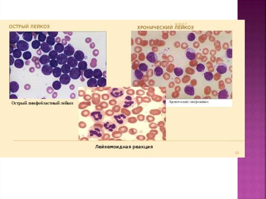 Лейкозы лейкемоидные реакции