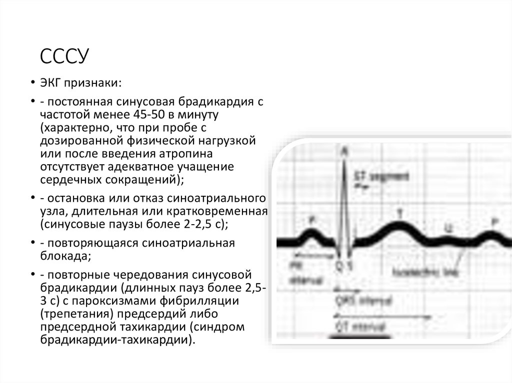 Синусовая брадикардия неполная