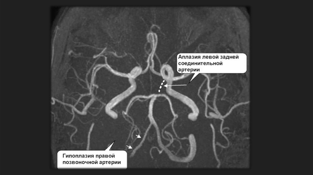 Сегмент v4 правой позвоночной артерии. Гипоплазия позвоночной артерии кт. Аномалии развития позвоночной артерии. Гипоплазия v4 позвоночной артерии. Гипоплазия правой позвоночной артерии на кт.