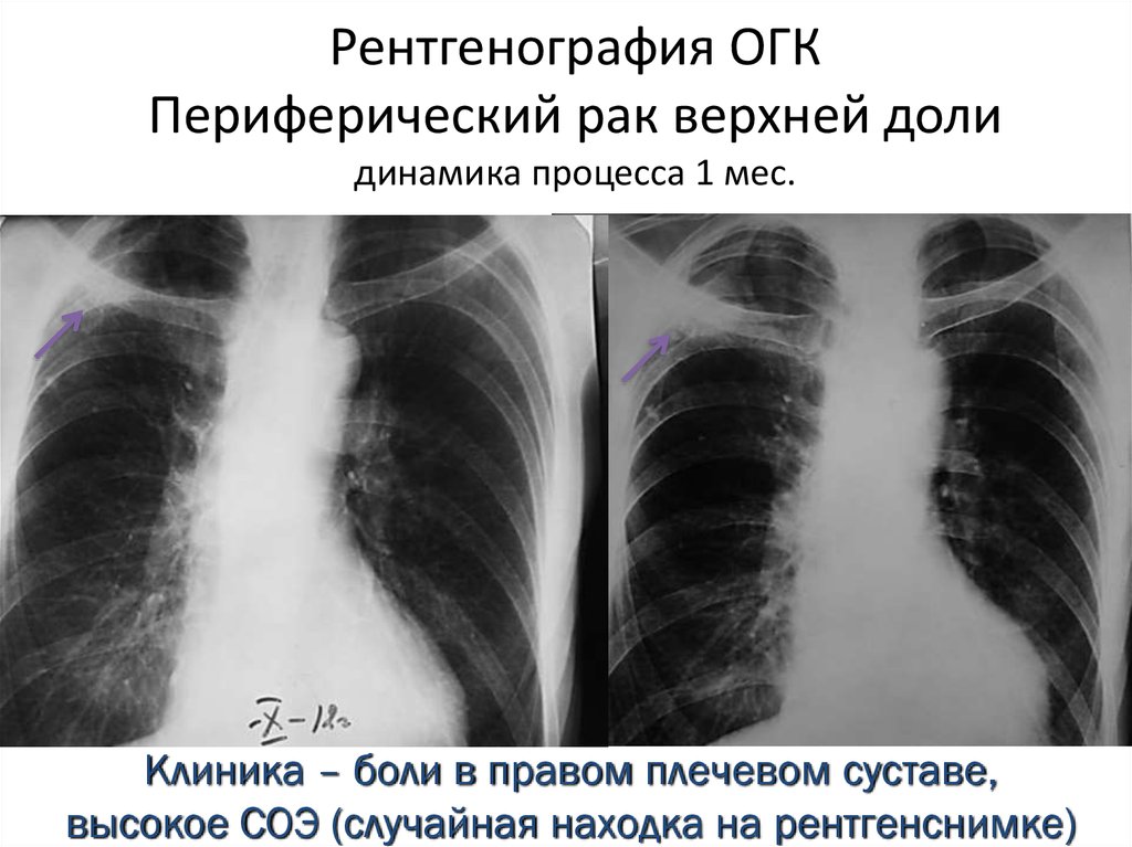 Периферический рак верхней доли. Perifericheskiy rak Legkovo na rentgenogramme. ККФ рентген ОГК. Периферический ра легкого рентег. Периферический РК легкого ренгтнг.