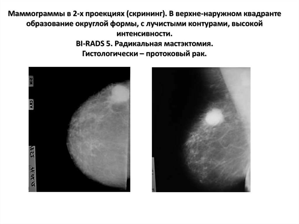 Фиброаденоматоз bi rads 2. Опухоль молочной железы маммограмма. Квадранты молочной железы на маммографии. Карцинома молочной железы маммография. Маммография микрокальцинаты.