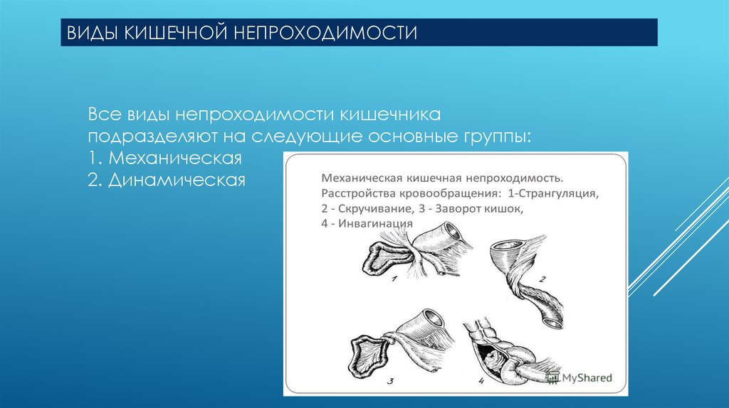 Механическая кишечная непроходимость презентация. Механическая обтурационная кишечная непроходимость. Обтурационная тонкокишечная непроходимость мкб 10. Обтурационный ШОК.