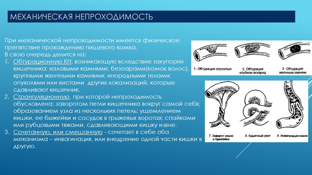 Острая кишечная непроходимость клиническая картина