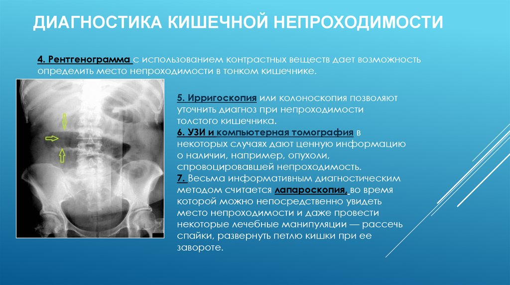 Приобретенная кишечная непроходимость у детей презентация