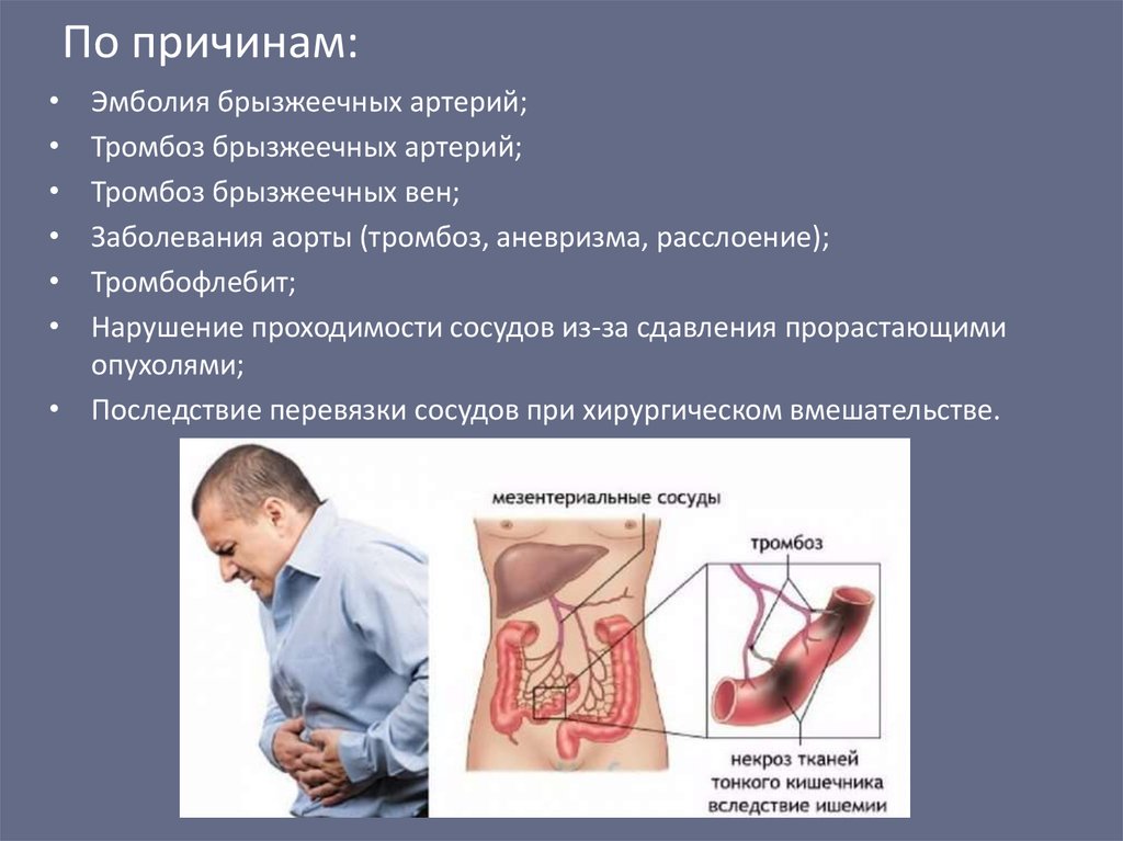 Синдром мезентериальной ишемии презентация