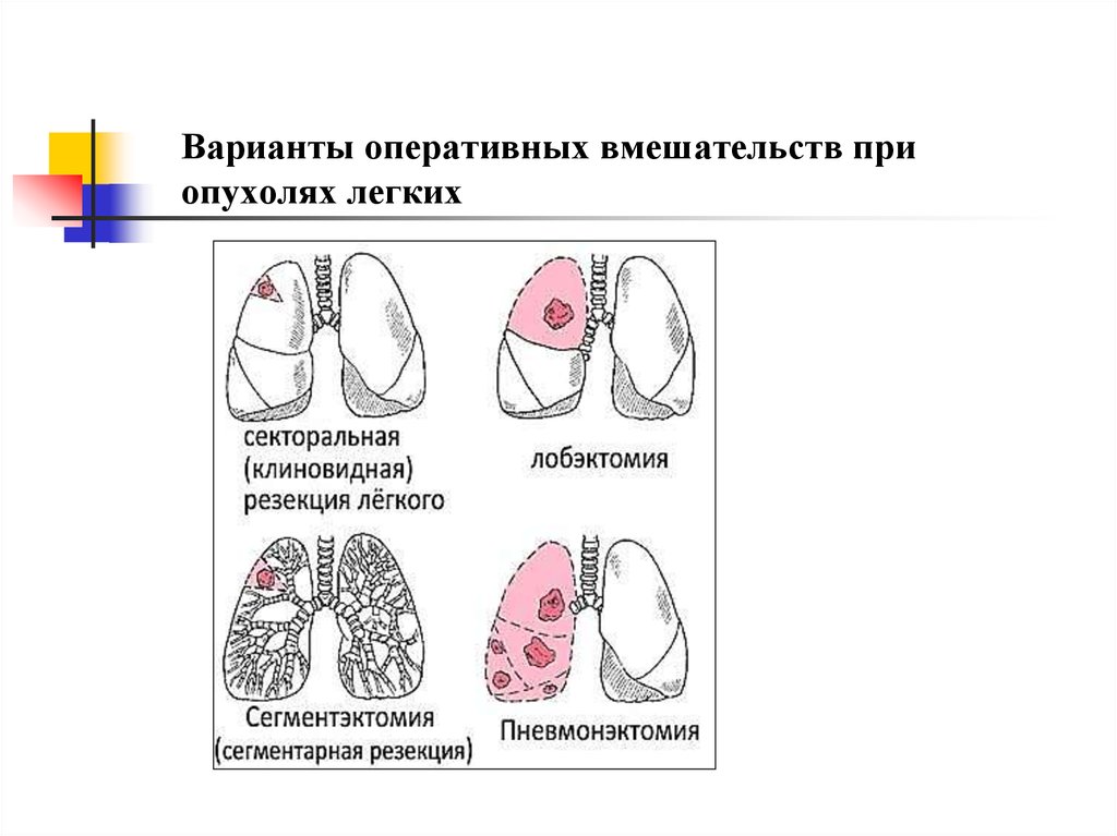 Операции на легких презентация