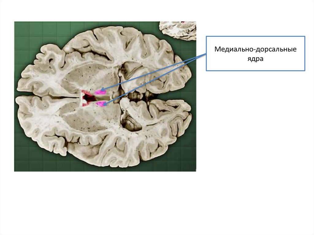 Фронтальный срез. Дорсальное медиальное ядро таламуса. Дорсальное ядро улитки. Фронтальный срез улитки.