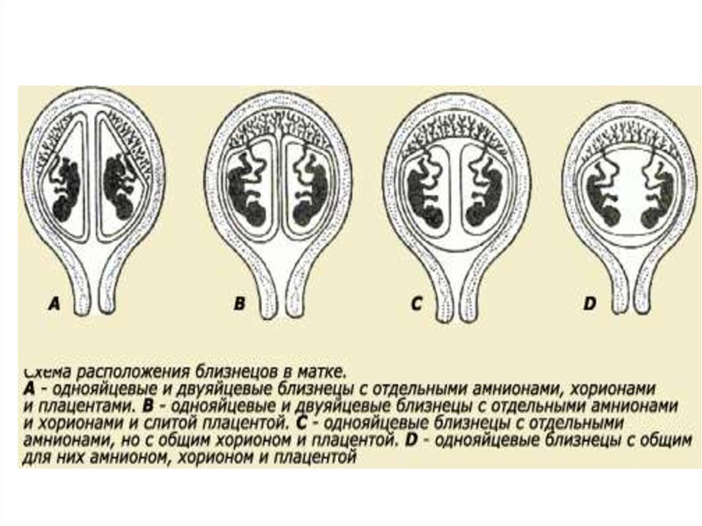 Признак близнецов. Расположение близнецов в матке. Однояйцевые и двуяйцевые.