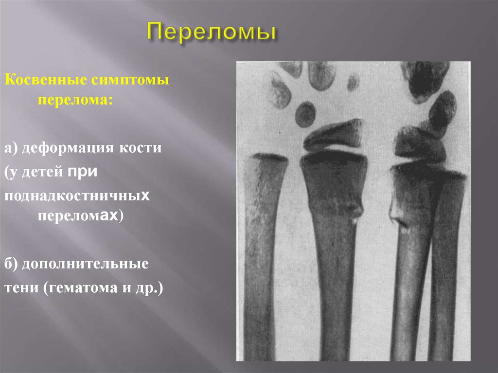 Симптомы трещины в кости. Поднадкостничный перелом костей рентген. Поднадкостничный перелом у детей. Наличие деформации костей.