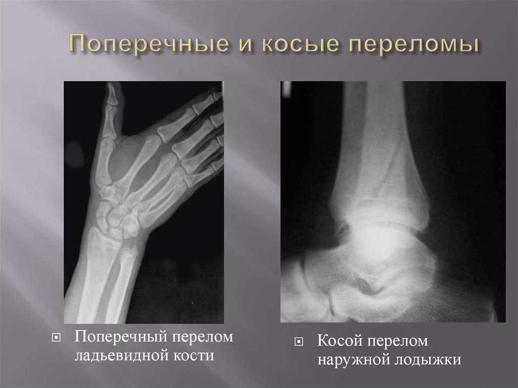 Косой перелом. Поперечный перелом ладьевидной кости. Поперечно оскольчатый перелом.