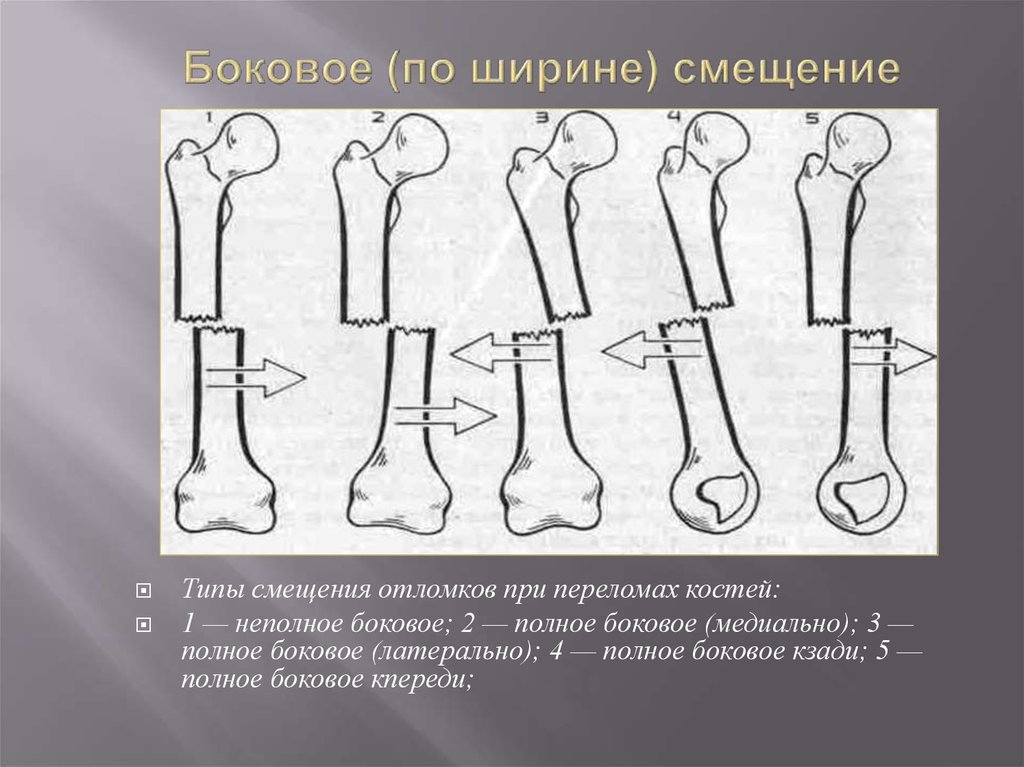 Смещение отломков кости. Ротационное смещение отломков. Краниальное смещение отломков. Классификация смещений костных отломков. Смещение отломков по периферии.