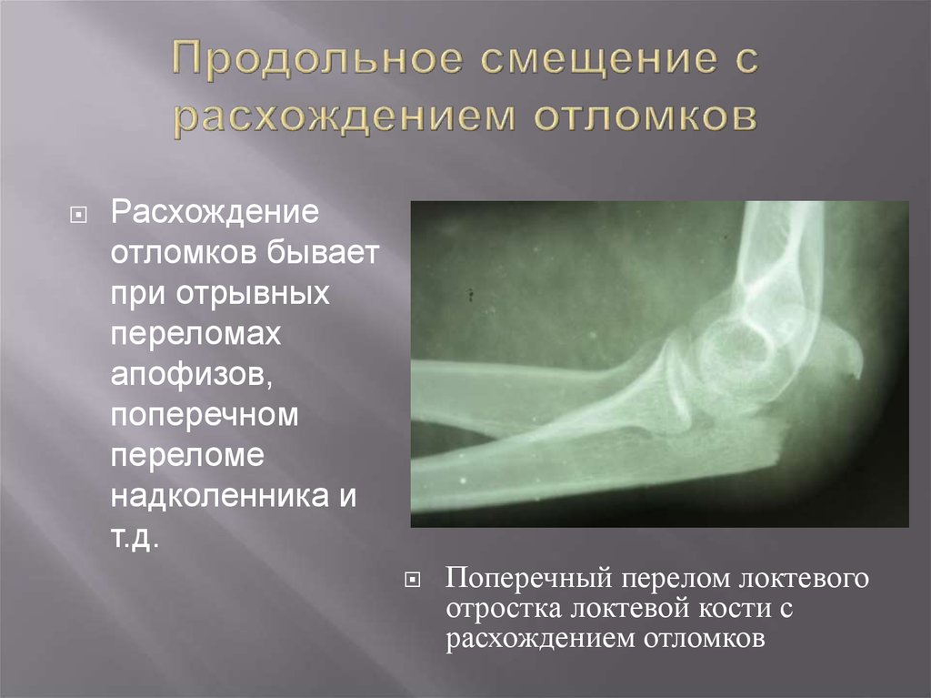 Диагноз кости. Перелом локтевого отростка со смещением рентген. Эпифизеолиз локтевого отростка. Перелом венечного отростка локтевой кости клиника. Перелом локтевого отростка рентген заключение.