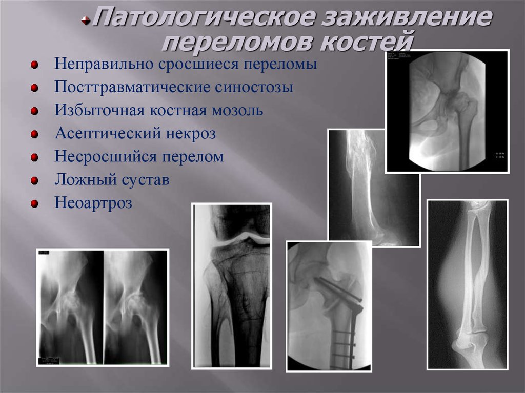 Сколько по времени заживает перелом. Эндостальная костная мозоль рентген. Этапы сращения перелома. Срастание костей при переломе.