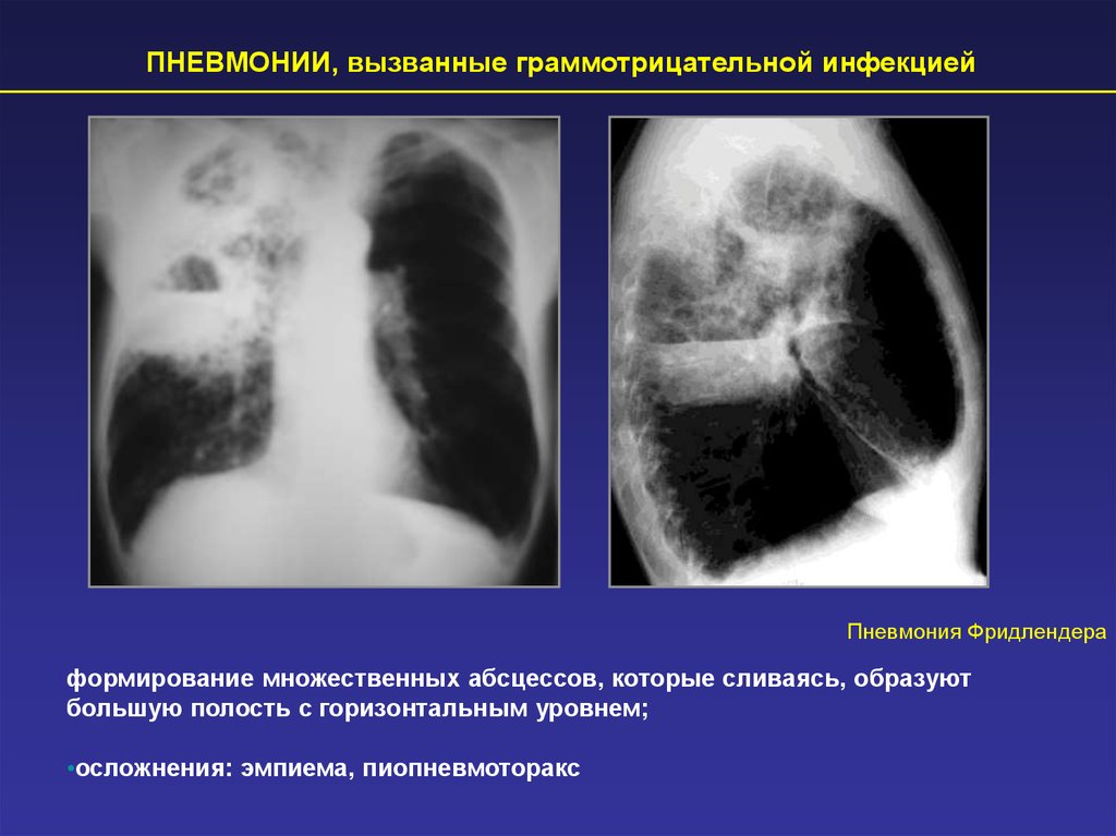 Вызывающие пневмонии. Фридлендеровская пневмония на рентгене. Клебсиелла пневмония рентген. Клебсиеллезная пневмония на кт. Клебсиеллезная пневмония рентген.