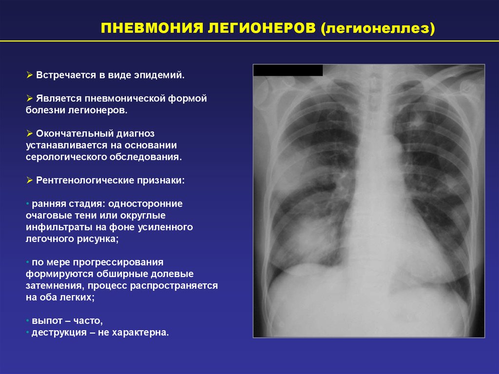 Гипостатические изменения в легких. Пневмония в стадии разрешения рентген. Легионеллезная пневмония рентген. Легионеллез пневмония кт. Рентген при легионеллезной пневмонии.