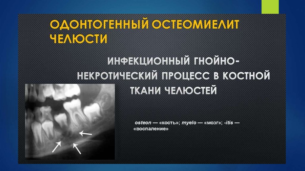 Презентация по хирургии остеомиелит