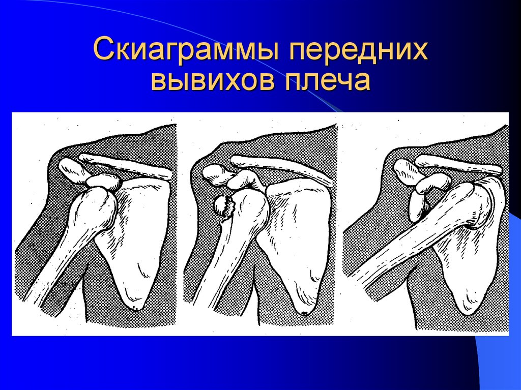 Вывихи плечевого сустава презентация