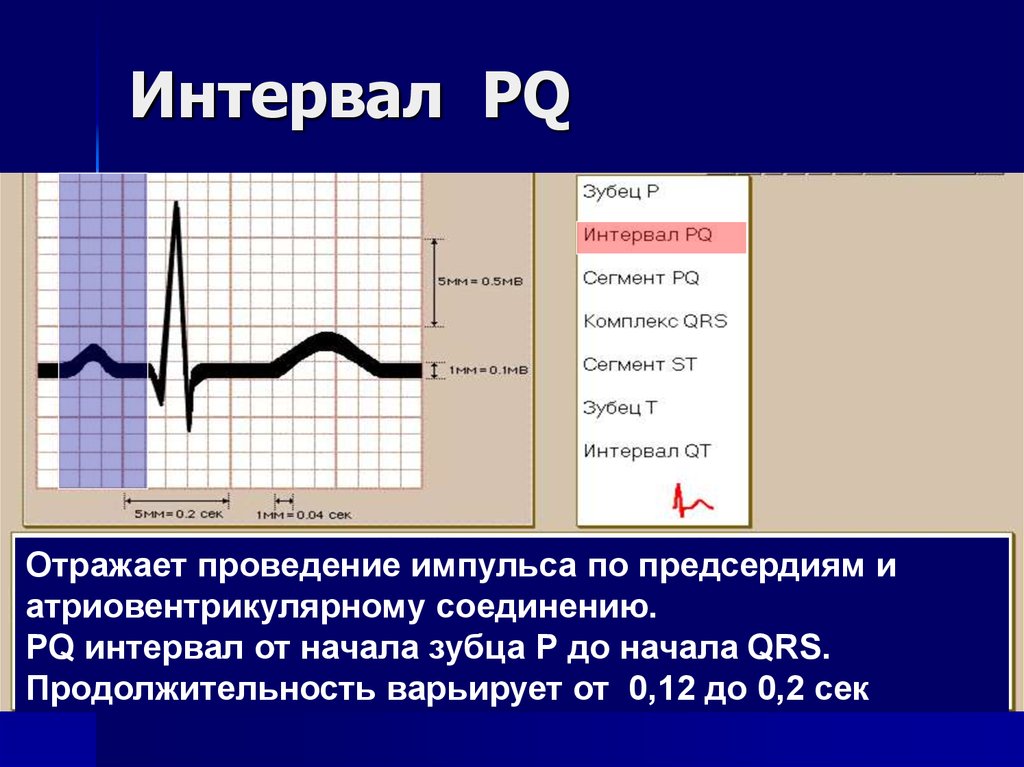 Срок экг перед операцией. Интервал PQ на ЭКГ норма. ЭКГ интервал PQ 0,34. QRS интервал PQ. Интервал PQ норма 0.22.