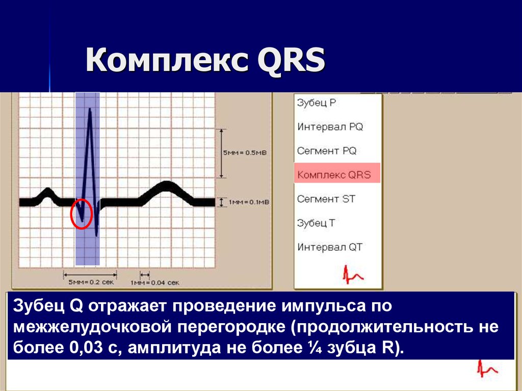 Qrs на экг что это. Расширение QRS на ЭКГ. Комплекс QRS. Расширение комплекса QRS. Комплекс QRS расширен.