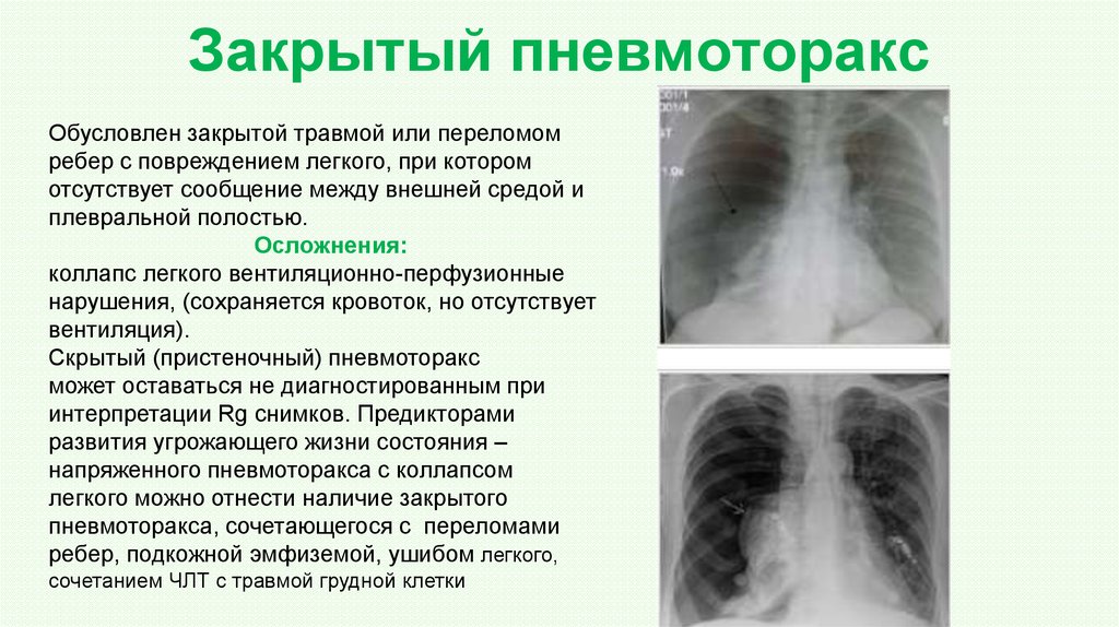 Закрытая травма легкого