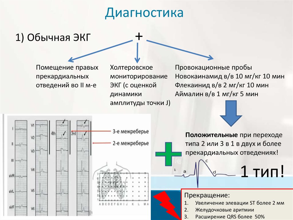 Синдром бругада презентация