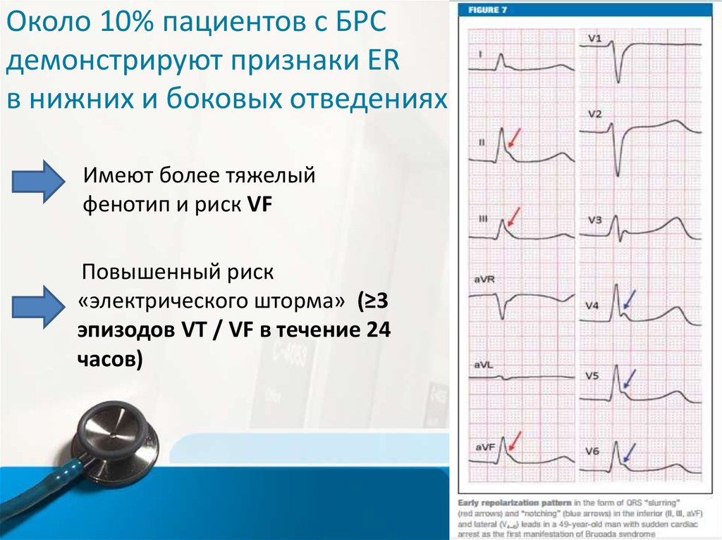 Синдром бругада на экг фото