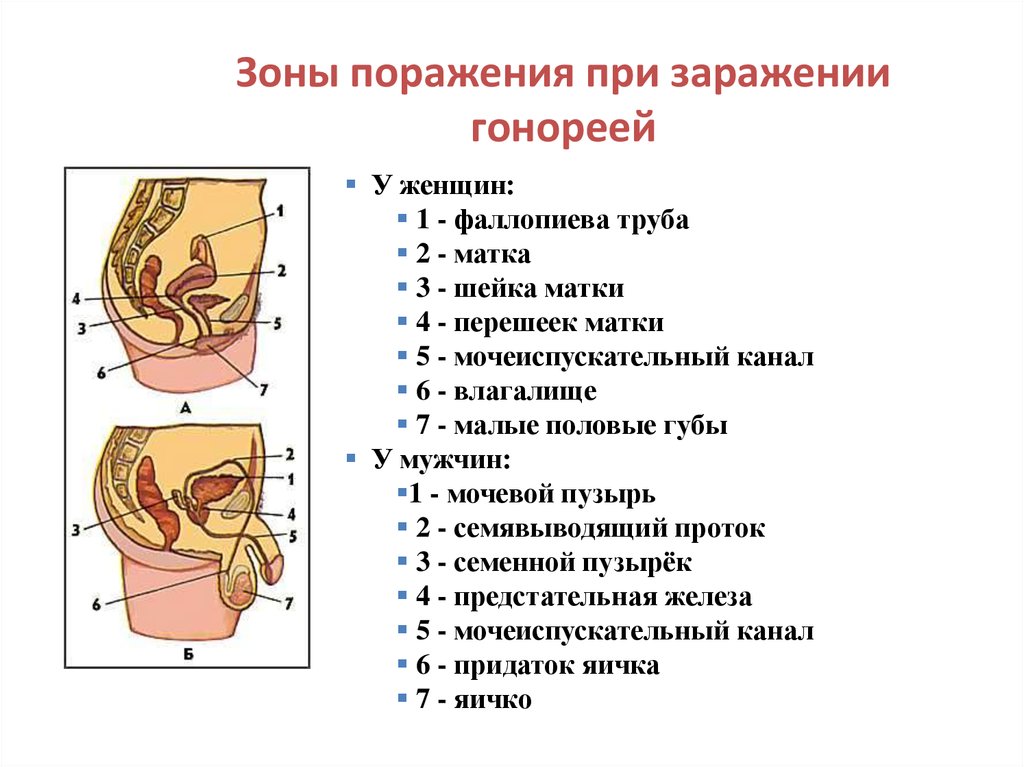 Для клинической картины восходящей гонореи характерно тест ответы