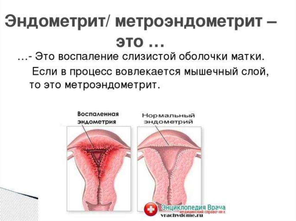 Воспаление матки у женщин симптомы и лечение. Эндомиометрит (метроэндометрит). Послеродовой эндометрит. Острый эндометрит матки.