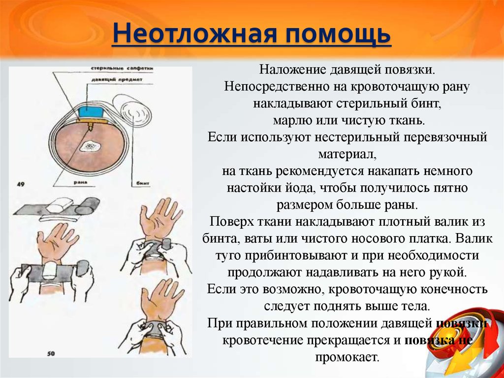 Наложение давящей повязки. Наложение стерильной давящей повязки. Давящая повязка на кровоточащую рану. Последовательность наложения давящей повязки.