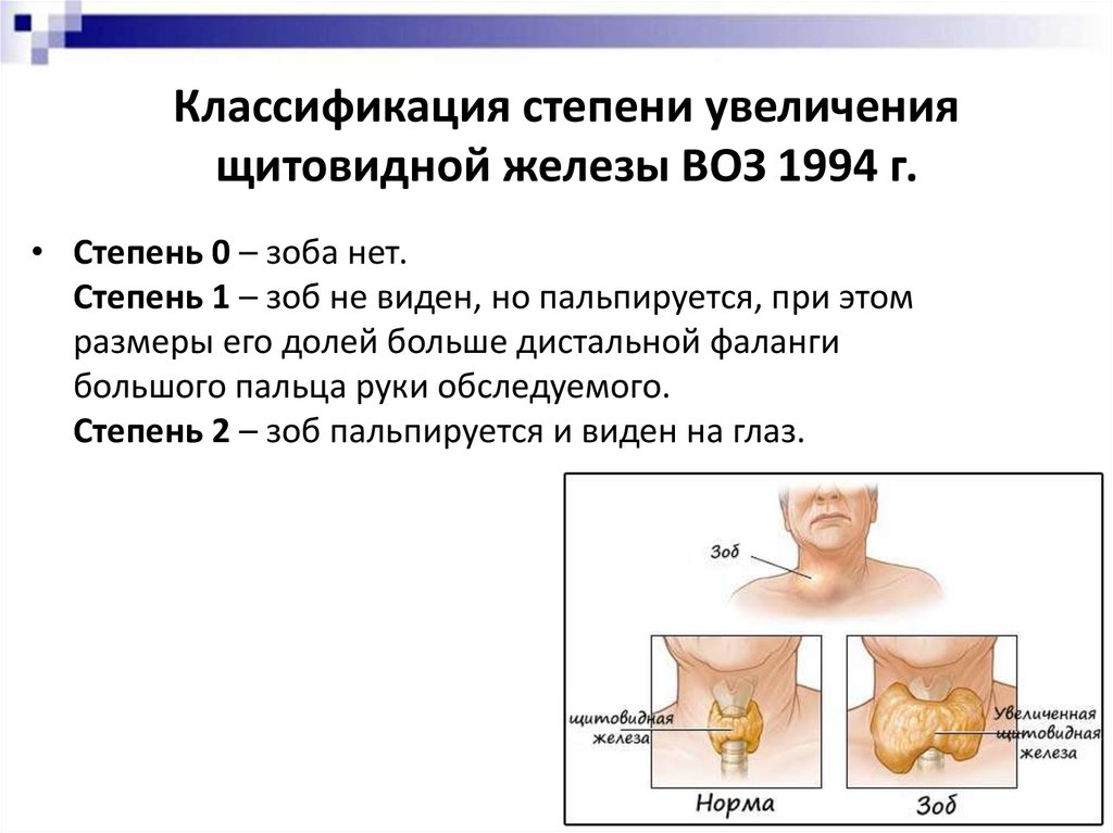 Структурные изменения щитовидной. Зоб ЩЖ классификация. Стадии узлового зоба щитовидной железы. Зоб щитовидной железы классификация 1 степени. Зоб 1 степени щитовидной железы что это.