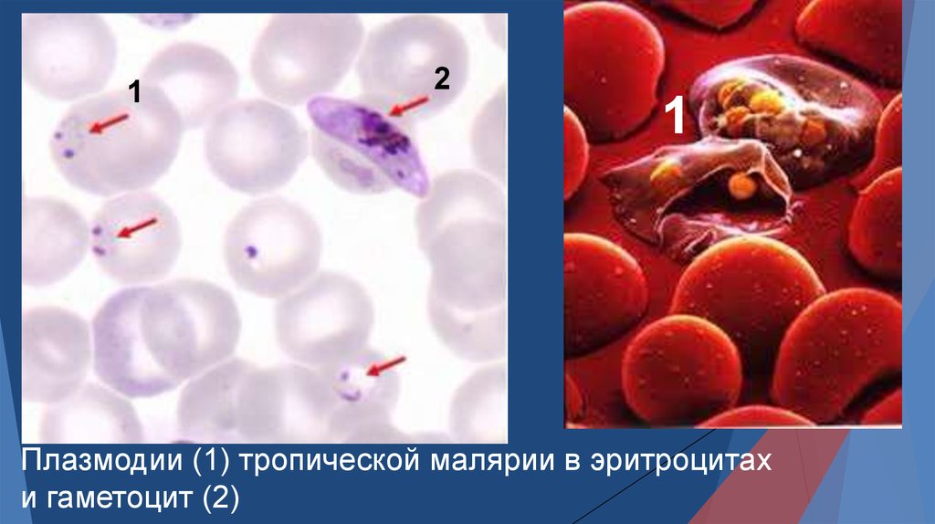 Изменение свойств эритроцитов при тропической малярии. Малярийный плазмодий в крови. Малярийный плазмодий возбудитель. Малярийный плазмодий осложнения.