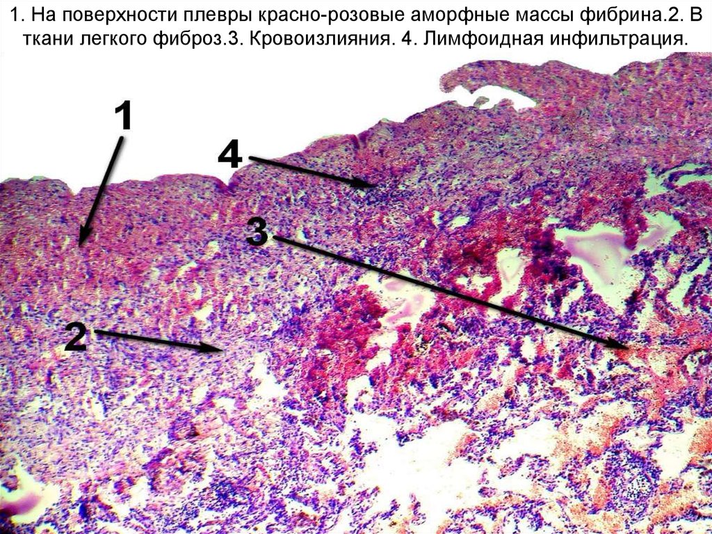 Фиброз мягких