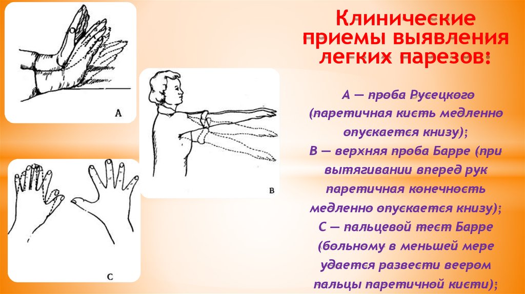 Нижняя проба барре. Пробы для выявления скрытых парезов. Проба Барре для верхних конечностей. Проба Мингаццини-Барре это.