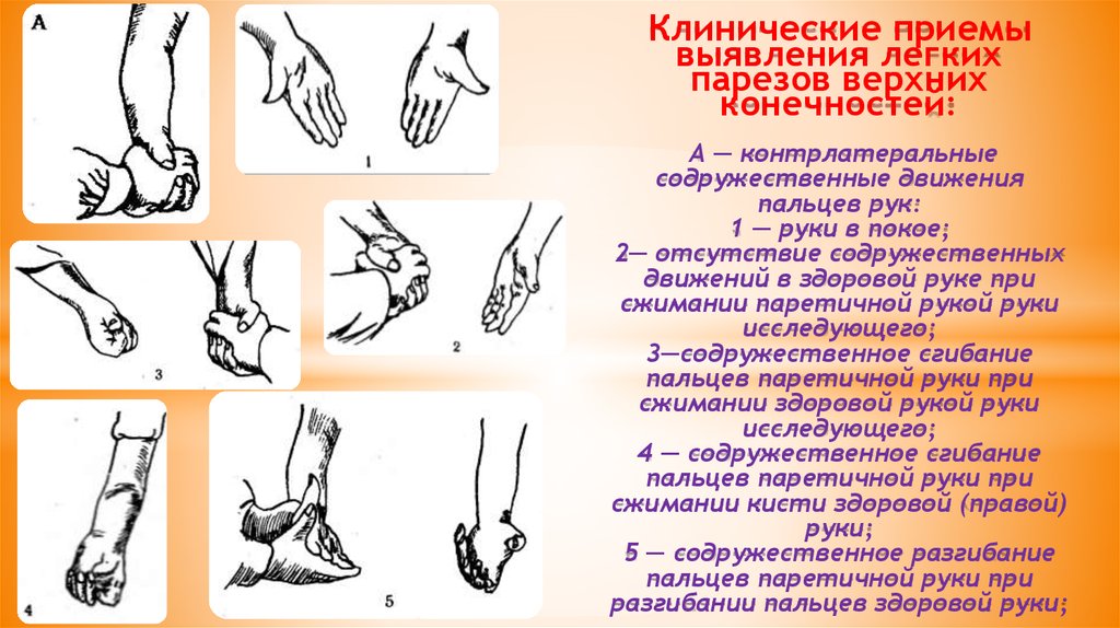 Клинический прием. Приемы для выявления парезов. Пробы для выявления пареза. Специальные приёмы для выявления парезов.