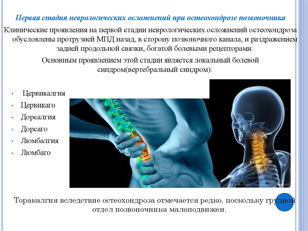 Пояснично крестцовый остеохондроз