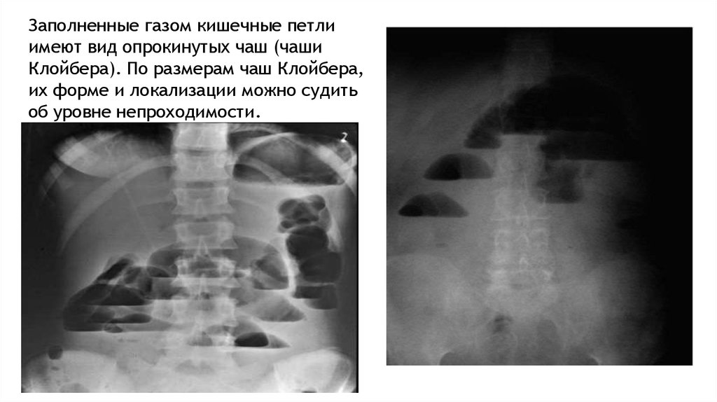 Непроходимость кишечника на рентгене фото