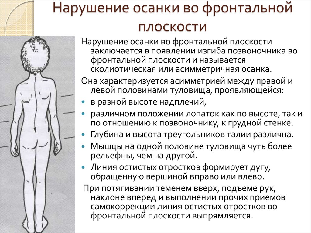 Какие нарушения осанки. Дефекты осанки во фронтальной плоскости. Отклонения в сагиттальной плоскости позвоночника. Нарушение осанки в сагиттальной и фронтальной плоскости. Нарушение осанки в сагиттальной плоскости у детей.