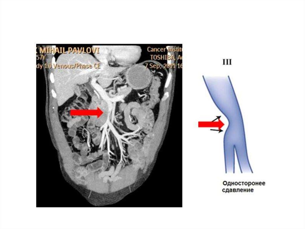 Мезентериальный тромбоз код. Мезентериальный венозный тромбоз кт. Тромбоз воротной вены на кт. Сдавление верхней брыжеечной артерии. Тромбоз мезентериальных артерий.