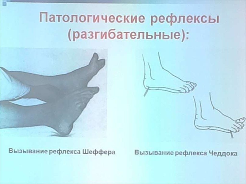 Патологические рефлексы. Патологические рефлексы Бабинского и Чеддока. Патологические стопные разгибательные рефлексы. Рефлекс Чеддока. Патологические разгибательные рефлексы Оппенгейма.